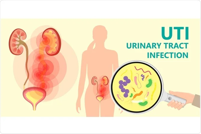 Urinary Tract Infection in Female - Important Things to Know