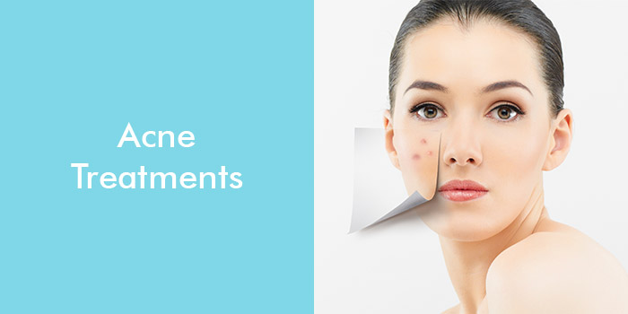 Acne Treatments: Scars Free Skin Home Remedies, Natural Treatments