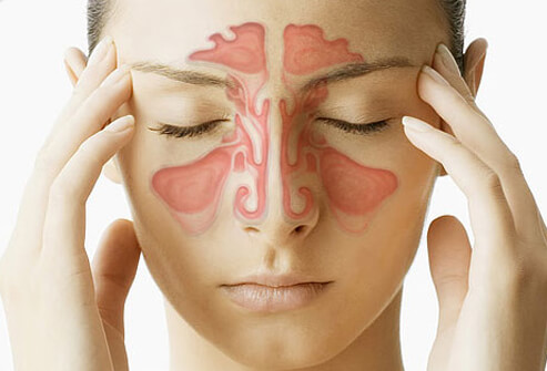 Easy Tips to Get Fast Relief From Sinus Headache at Home