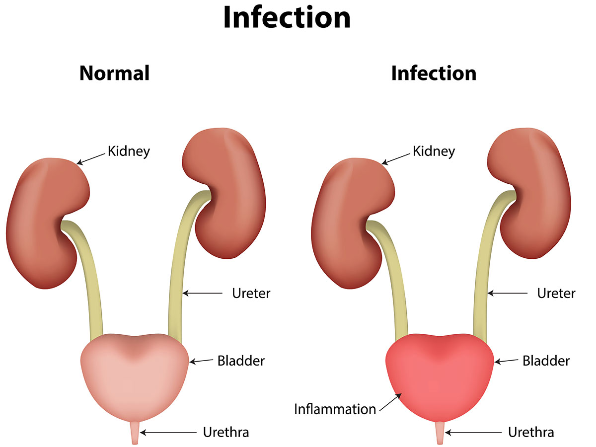 Home Remedies For Urinary Tract Infection