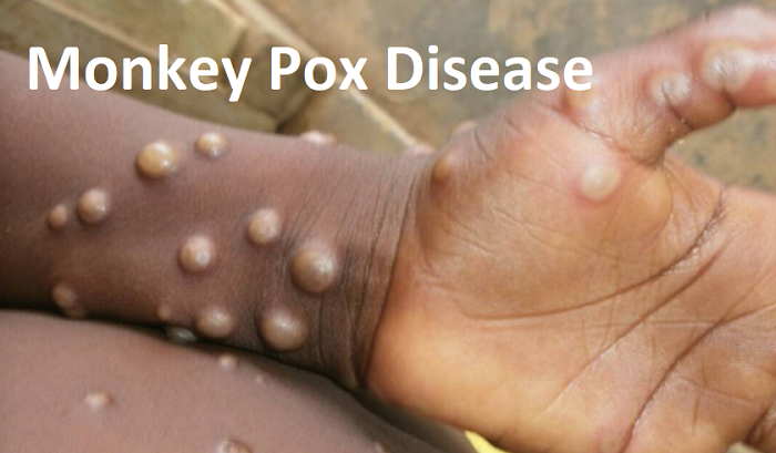 Things to Know About Monkeypox - Symptoms, Precautions, Treatment