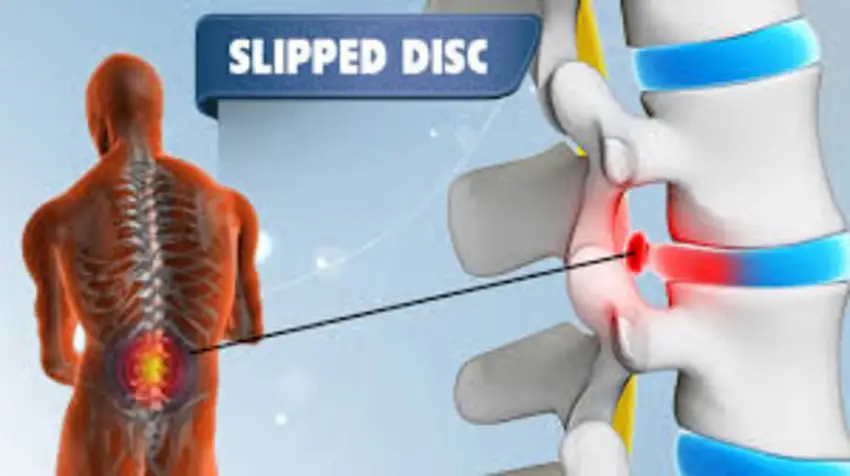 Easy Exercises for Slipped Disc Pain Relief